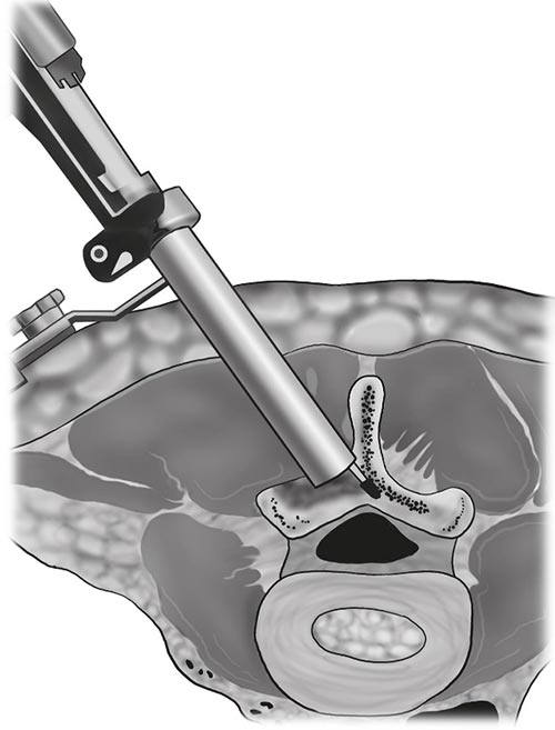 estenose do canal vertebral estenose lombar 4