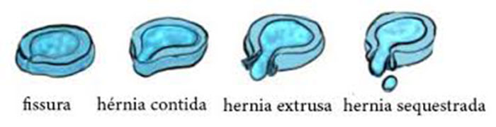hernia discal lombar 3